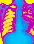Coloured X-ray of human chest showing pulmonary TB