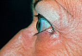 Bulging eye in elderly woman with Graves' disease