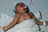Baby in hospital with tetanus,muscle spasm