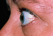 Bulging eye of person with thyrotoxicosis