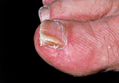 Trichophyton fungal infection of toenail