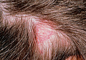 Tinea capitis: ringworm of the scalp (lesion)