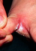 Close-up of athlete's foot (Tinea pedis) infection