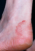 Athlete's foot infection