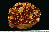 Spleen in tuberculosis