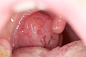 Enlarged tonsil of a 12 year old