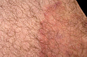 Ringworm fungal infection