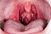 Inflamed tonsils