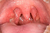 Bacterial tonsillitis