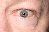 Swollen eye in thyrotoxicosis