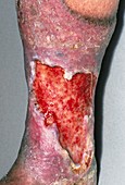 Varicose ulcer on elderly person's leg