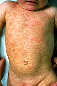Urticaria pigmentoseon child's body