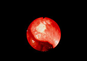 Endoscope image of ulcer of duodenal bulb