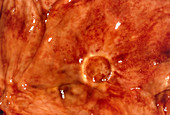 Clincal photo of stomach ulcer