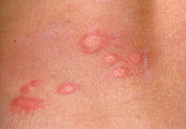 Urticaria skin rash of the back of a patient