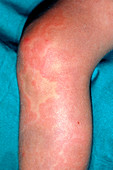 Allergic urticaria on leg