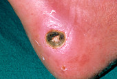 Close-up of a diabetic ulcer on the heel of a foot