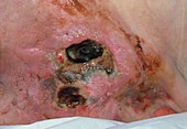Close up of sacral ulcer (pressure sore)