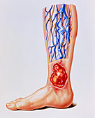 Artwork of varicose veins & ulcer on leg