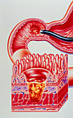 Artwork of duodenal ulcer with magnified view