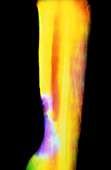 Coloured X-ray of erosion of tibia due to ulcer