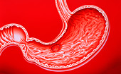 Artwork showing gastric ulcer