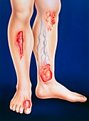 Artwork showing different types of leg ulcer