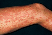 Urticaria rash (hives) on legs due to exam stress