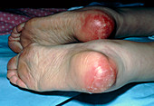 View of heels developing bedsores