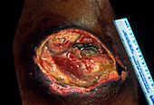 Close-up of a very large ulcer on a patient's skin