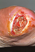 Ulcer