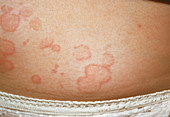 Urticaria rash