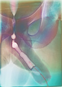 Urethritis,X-ray