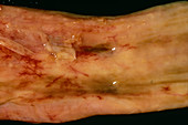 Oesophageal ulcer