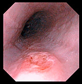 Oesophagus ulcer