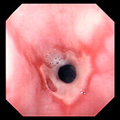 Oesophagus ulcer