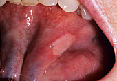 Major aphthous ulcer