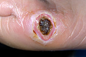 Diabetic ulcer on a patient's foot
