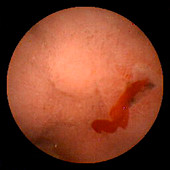 Bleeding duodenal ulcer,pill camera view