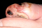 Infected toe caused by diabetes