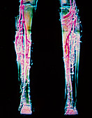 Venogram of legs showing varicose veins