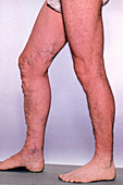 Varicose veins affecting legs and feet of male