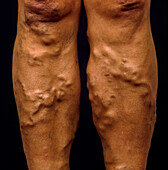 Varicose veins on a woman's legs below the knee