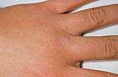 Common warts on the hand