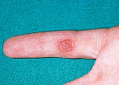 Large common wart on the finger