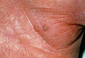 View of two warts on the palm of a hand