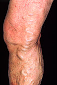 Varicose veins affecting the leg of an elderly man