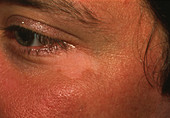 Vitiligo seen next to an eye