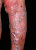 Varicose veins