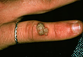 Common wart